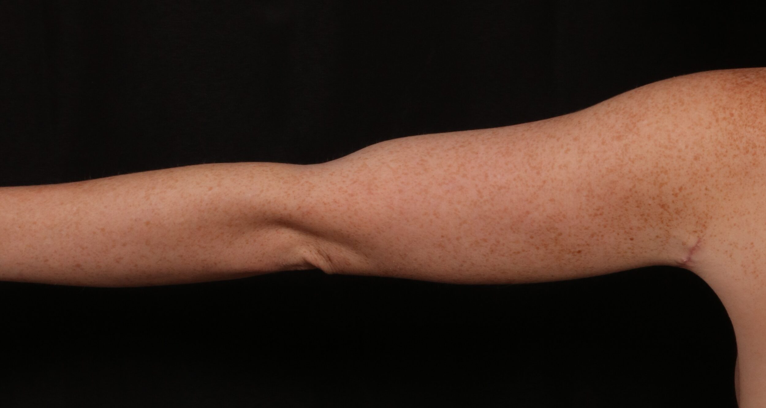 After Image: Brachioplasty - back
