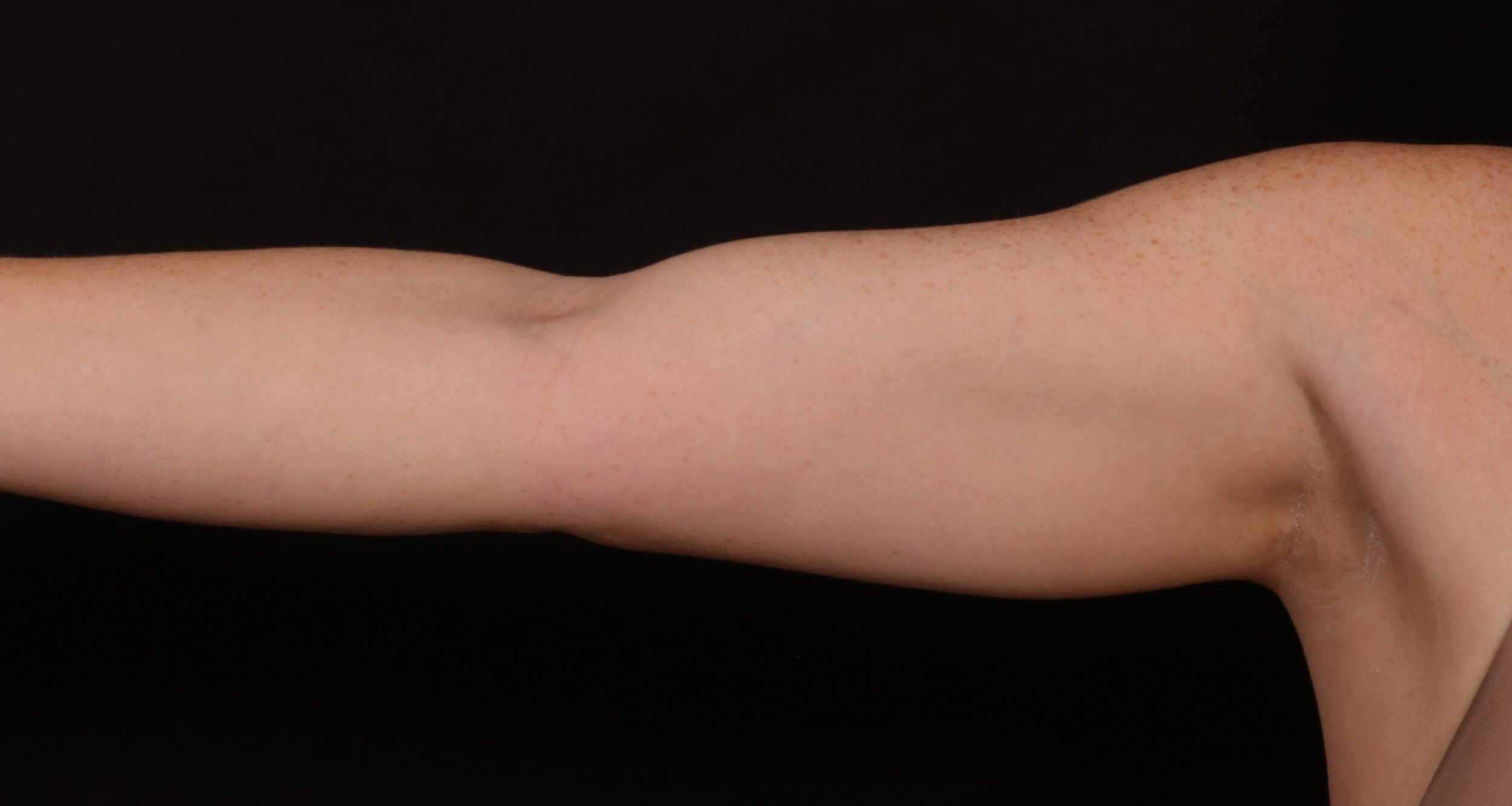 Before Image: Brachioplasty - front
