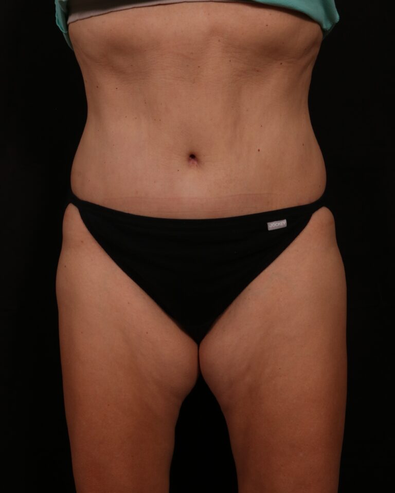 After Image: Tummy Tuck - front