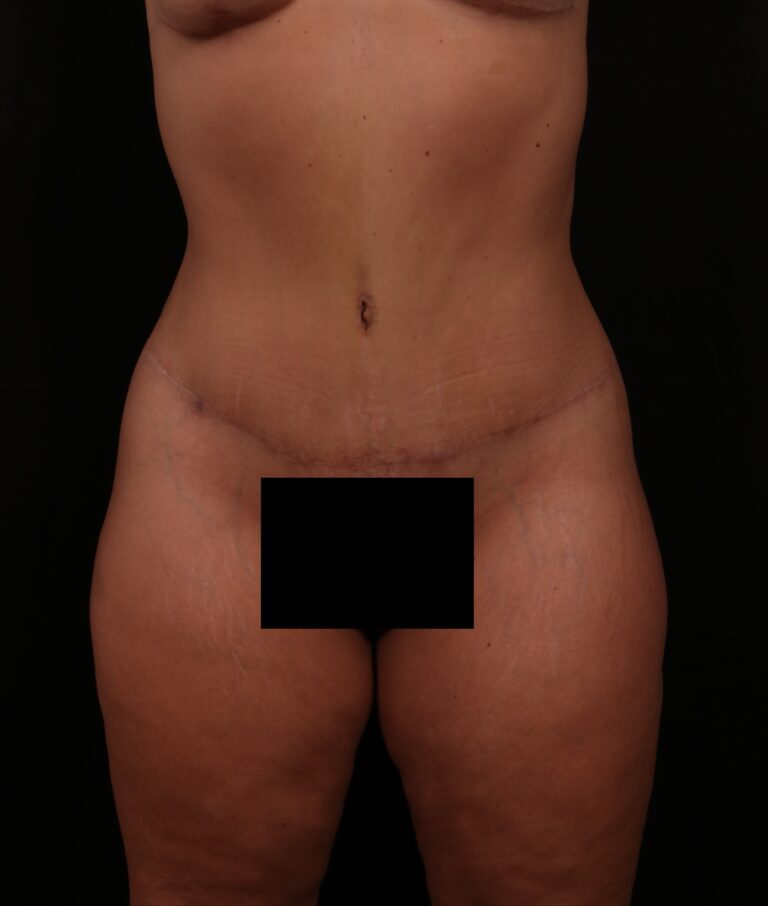 After Image: Tummy Tuck - front