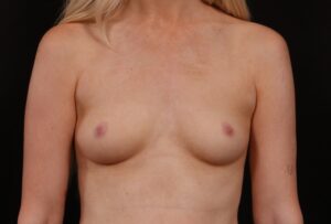 Before Image: Breast Augmentation