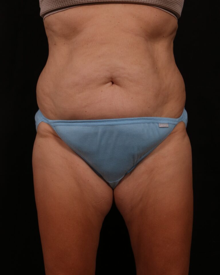 Before Image: Tummy Tuck - front