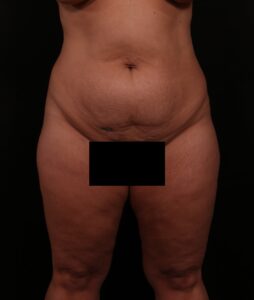 Before Image: Tummy Tuck