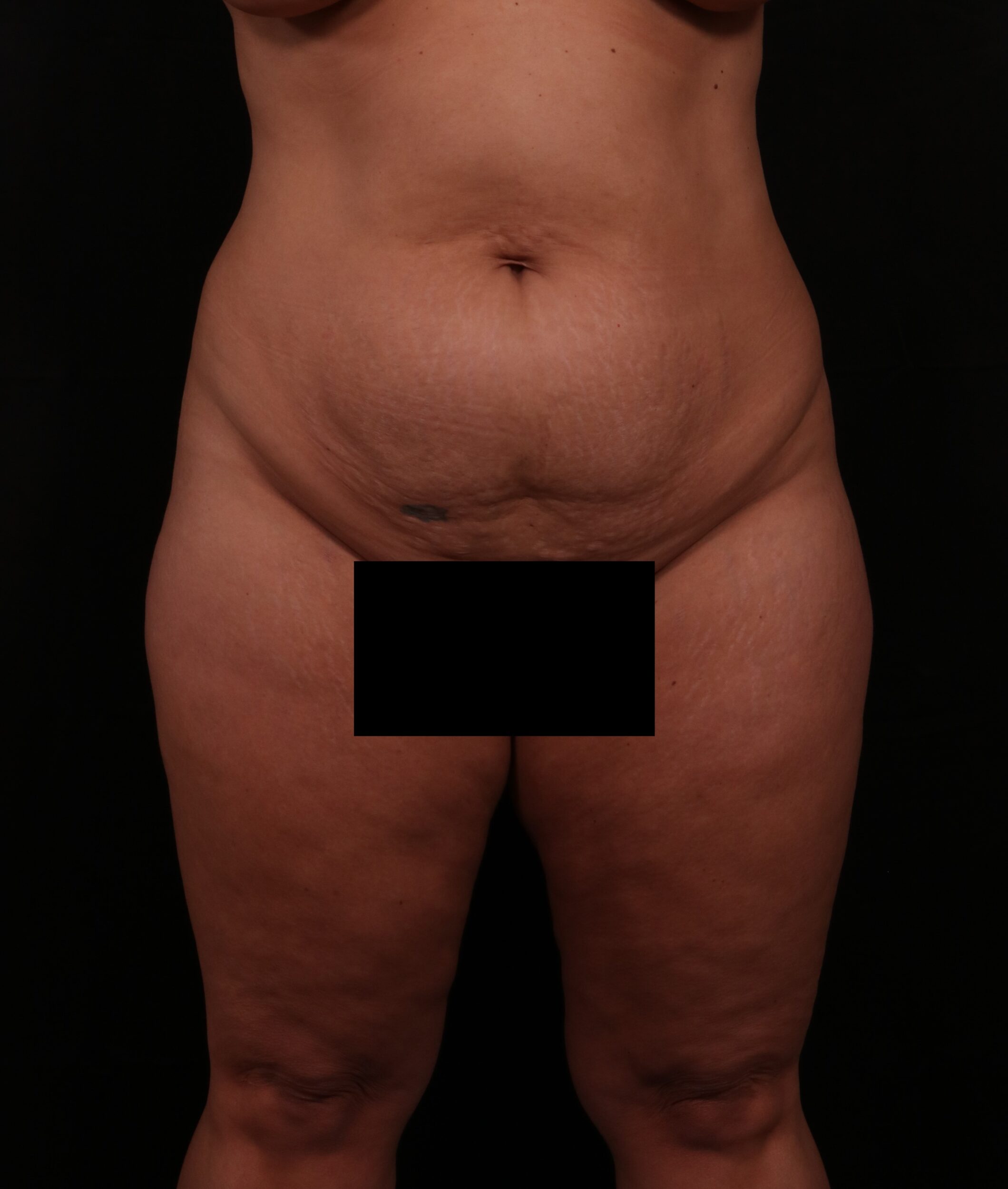 Before Image: Tummy Tuck - front