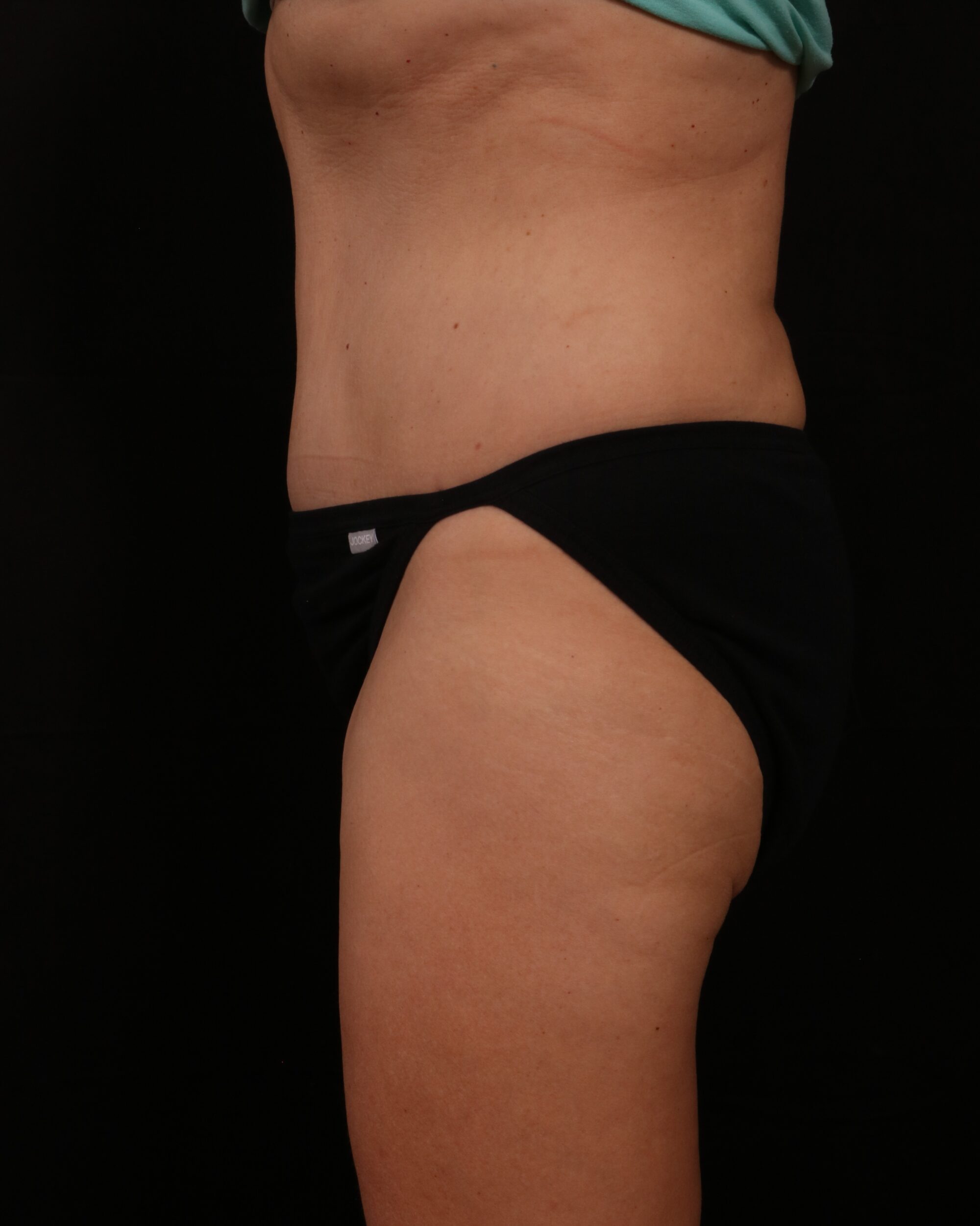 After Image: Tummy Tuck - left-side