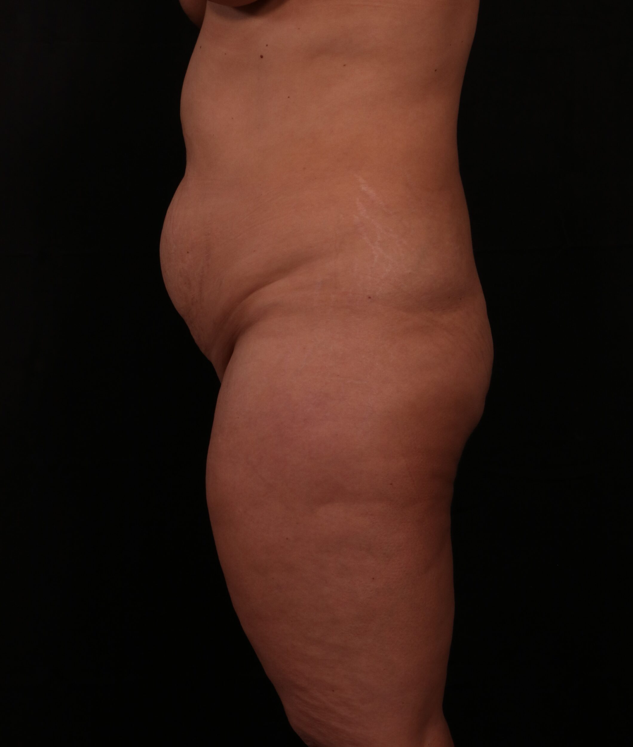 Before Image: Tummy Tuck - left-side
