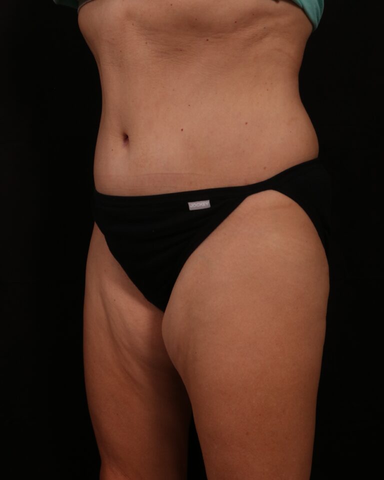 After Image: Tummy Tuck - left-front-oblique
