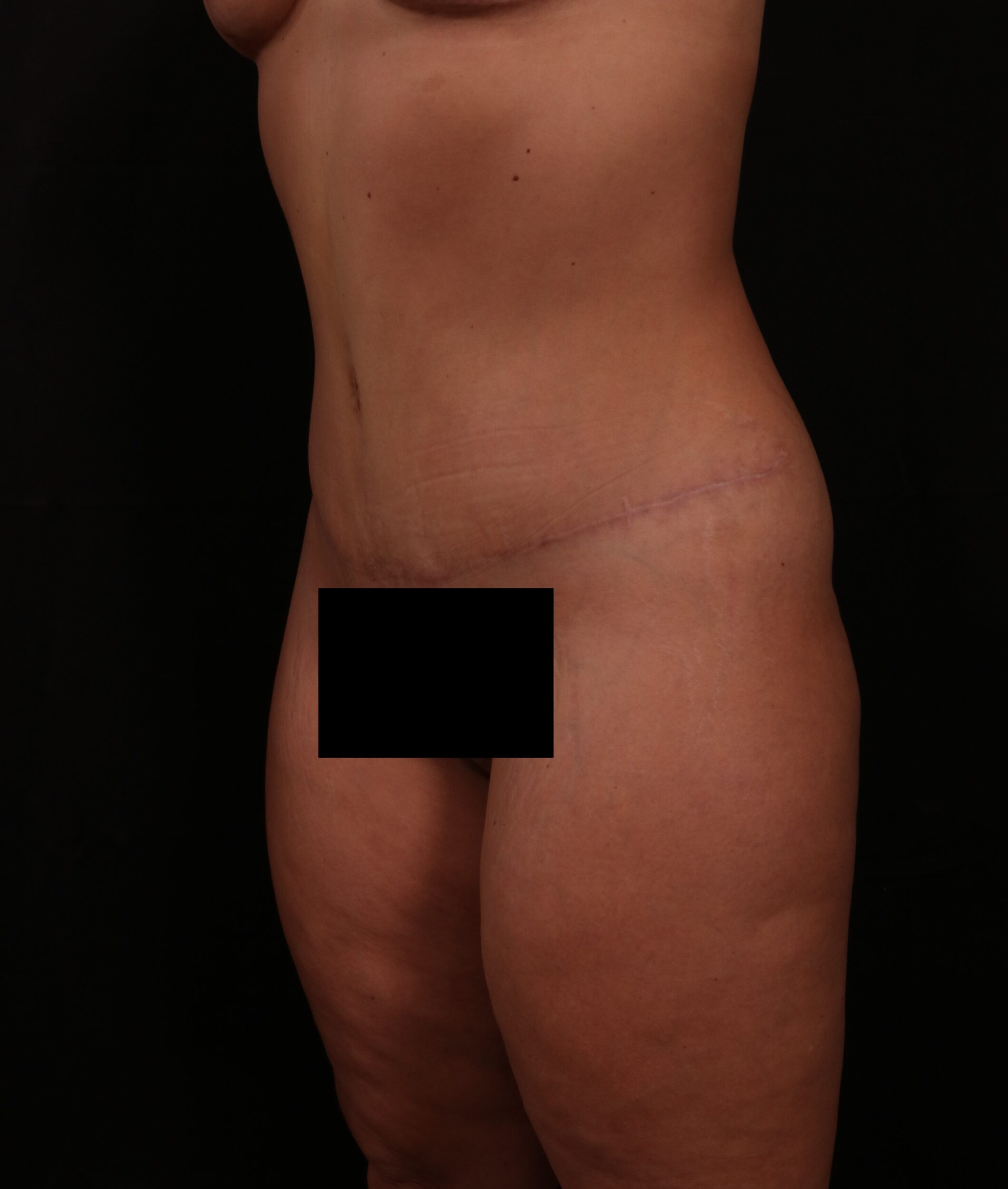 After Image: Tummy Tuck - left-front-oblique