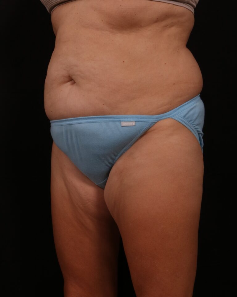 Before Image: Tummy Tuck - left-front-oblique