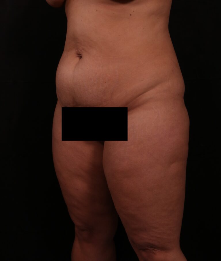 Before Image: Tummy Tuck - left-front-oblique