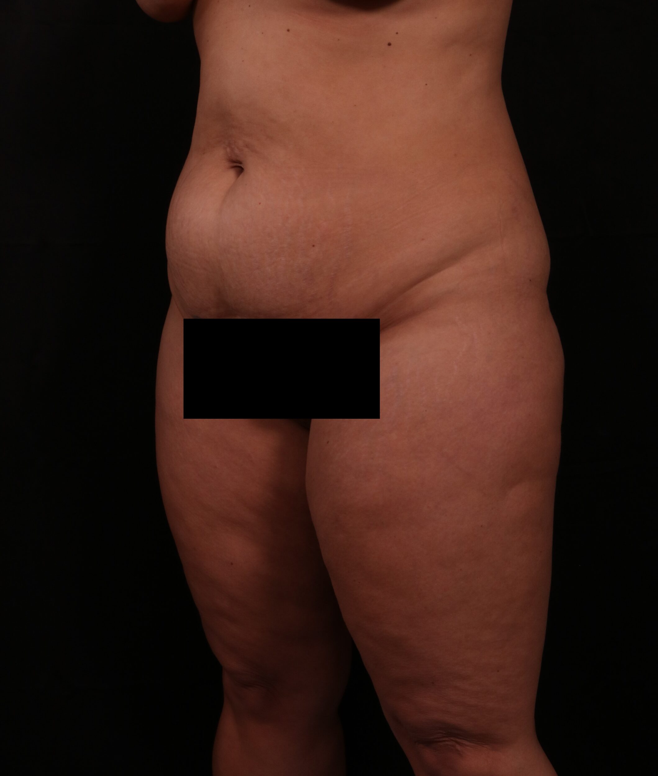 Before Image: Tummy Tuck - left-front-oblique