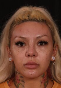 After Image: Brow lift