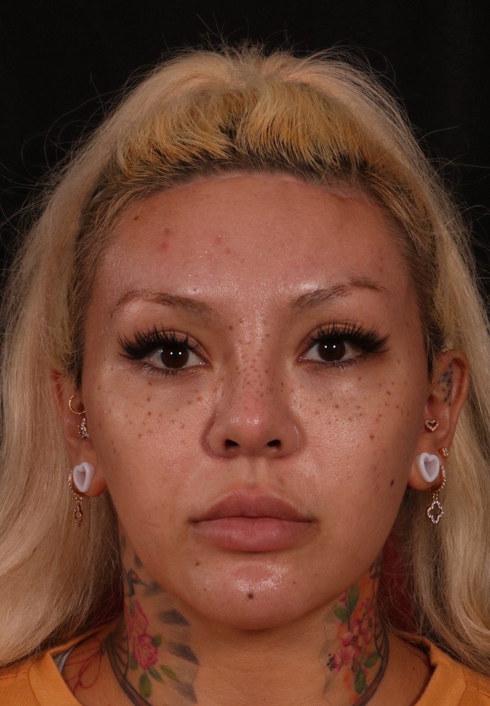 After Image: Brow lift - front