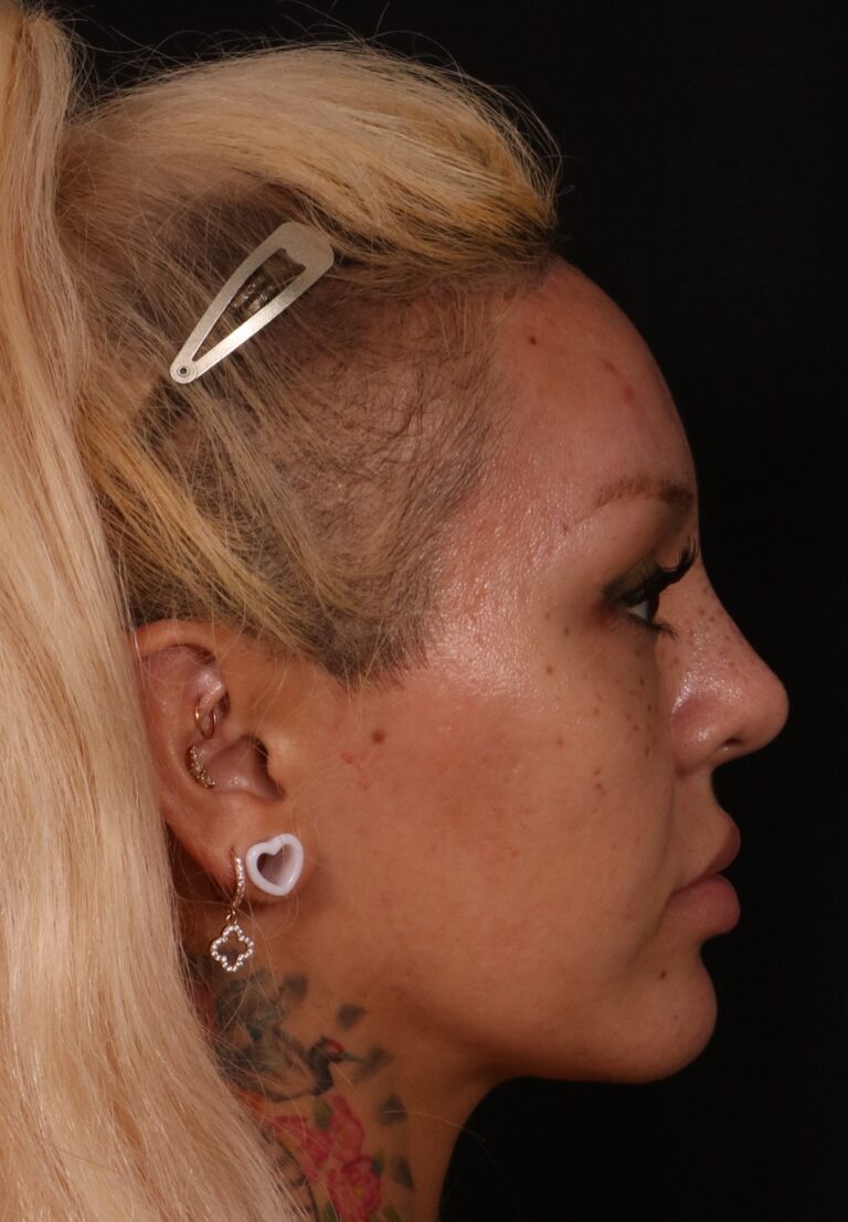 After Image: Brow lift - right-side