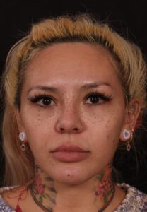 Before Image: Brow lift