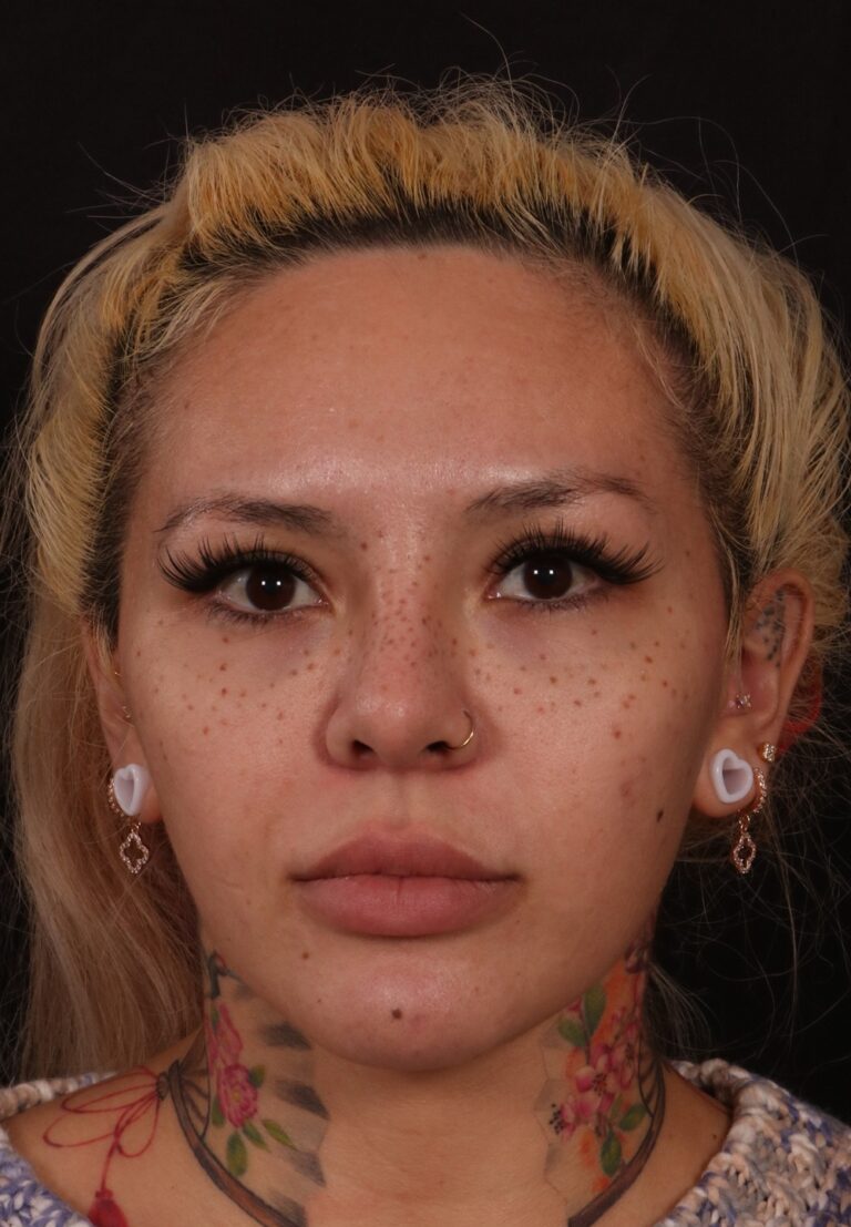 Before Image: Brow lift - front