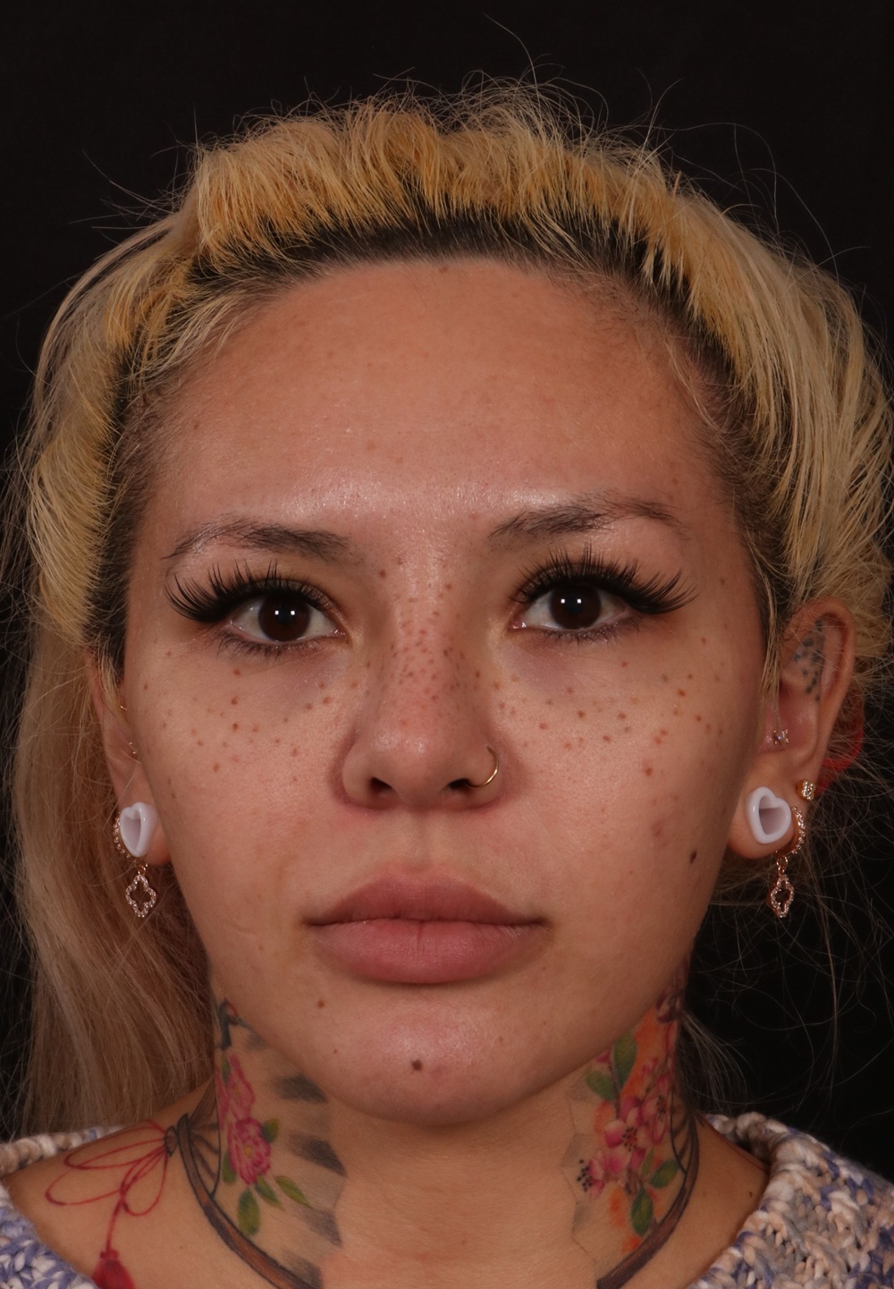 Before Image: Brow lift - front