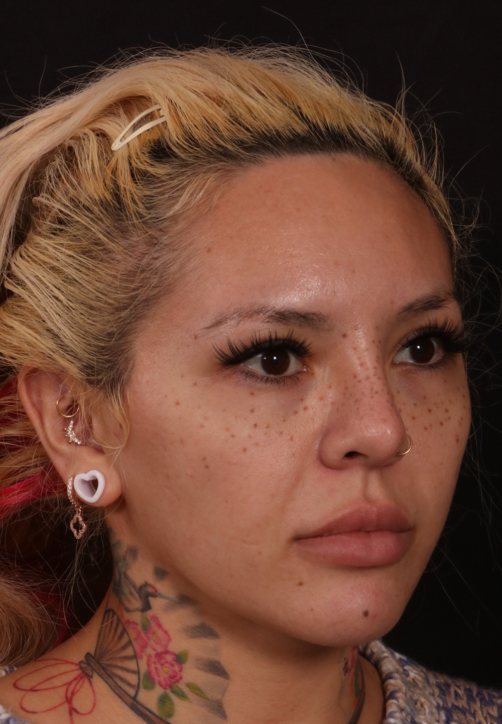 Before Image: Brow lift - right-front-oblique