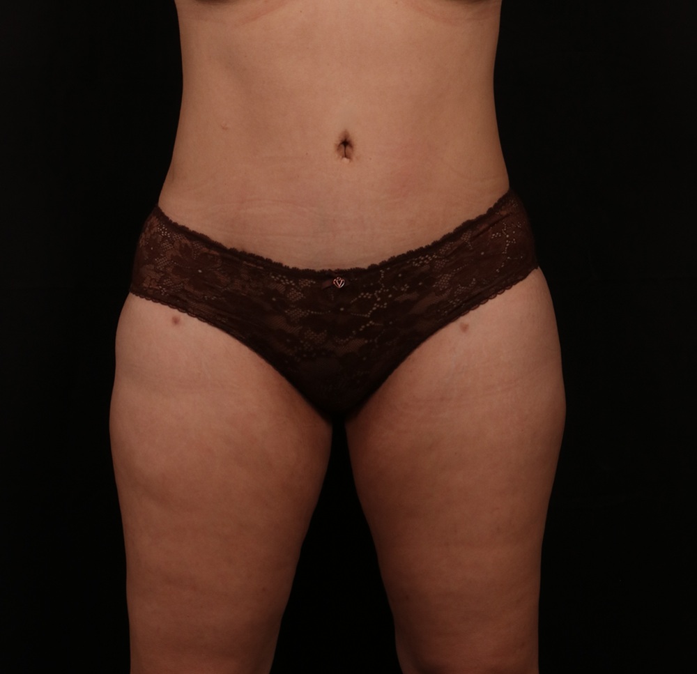 After Image: Tummy Tuck - front