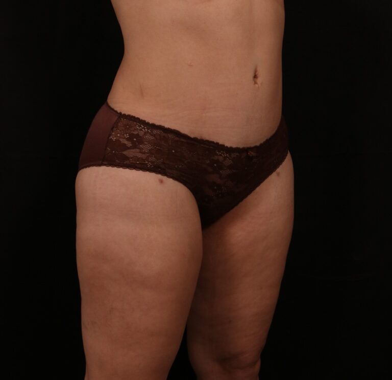 After Image: Tummy Tuck - right-front-oblique