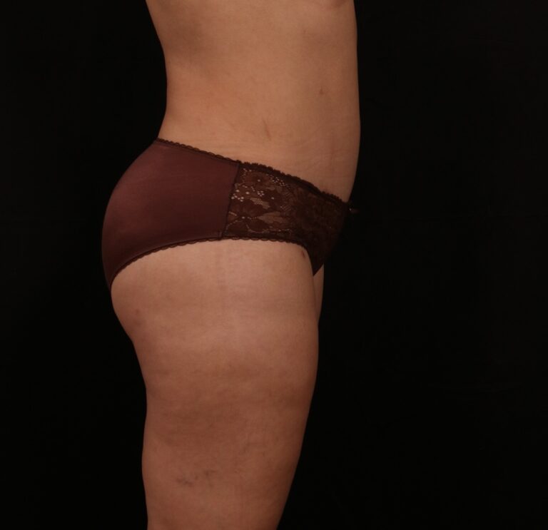 After Image: Tummy Tuck - right-side