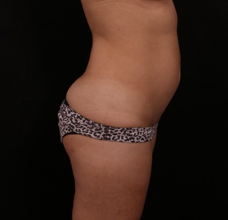 Before Image: Tummy Tuck - right-side