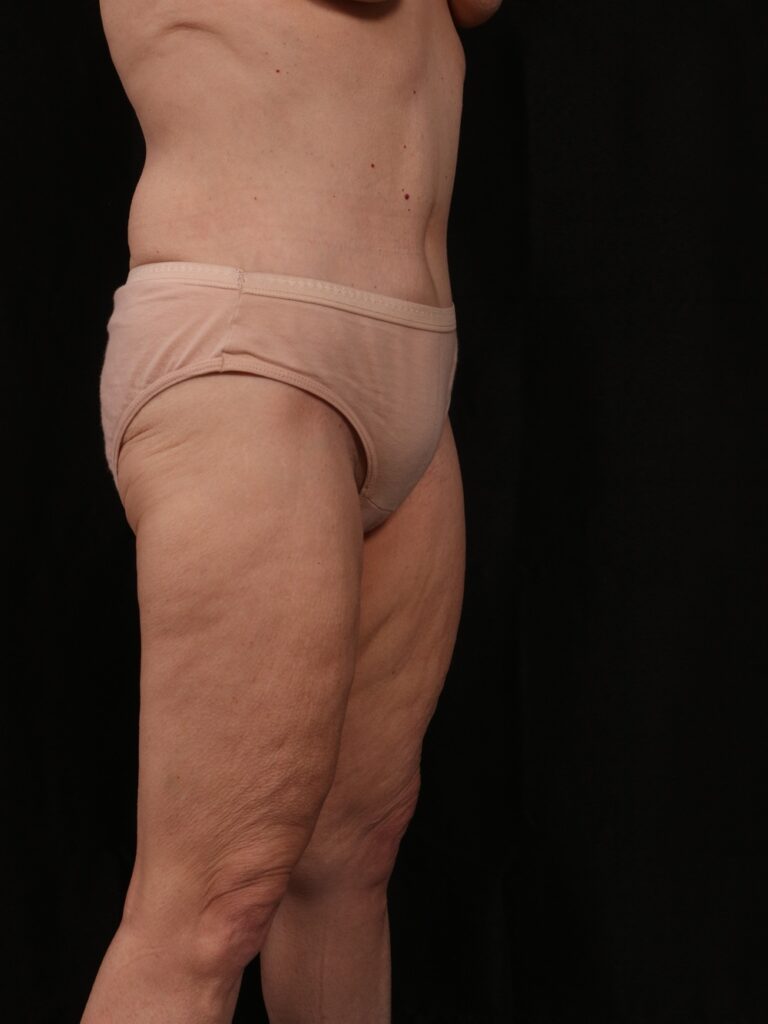 After Image: Tummy Tuck - right-front-oblique