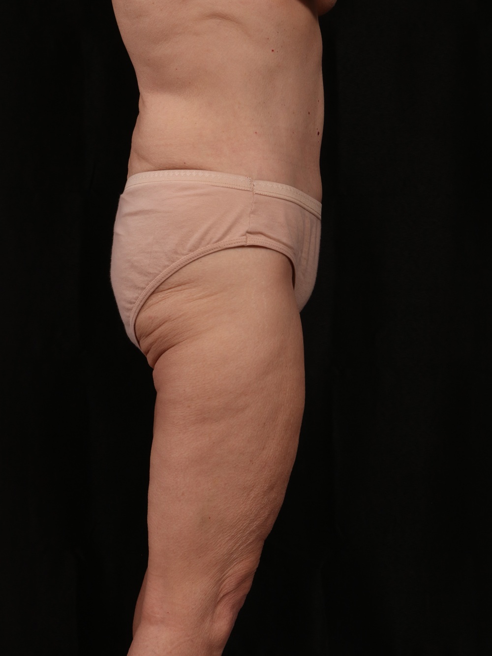 After Image: Tummy Tuck - right-side