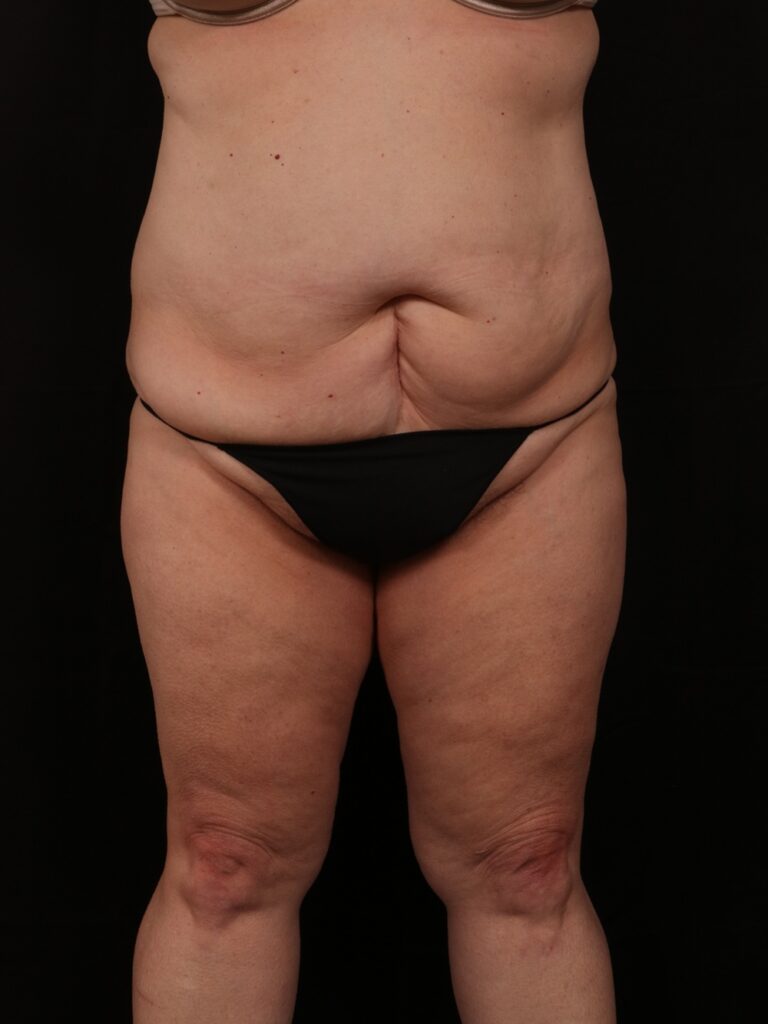 Before Image: Tummy Tuck - front