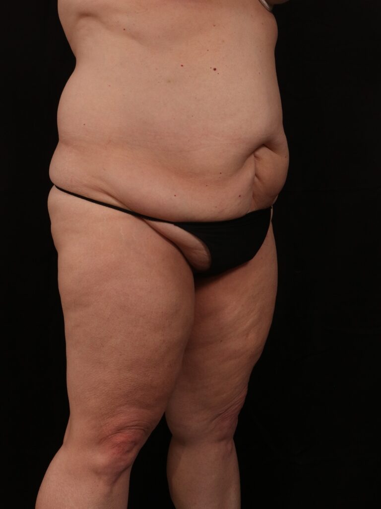 Before Image: Tummy Tuck - right-front-oblique