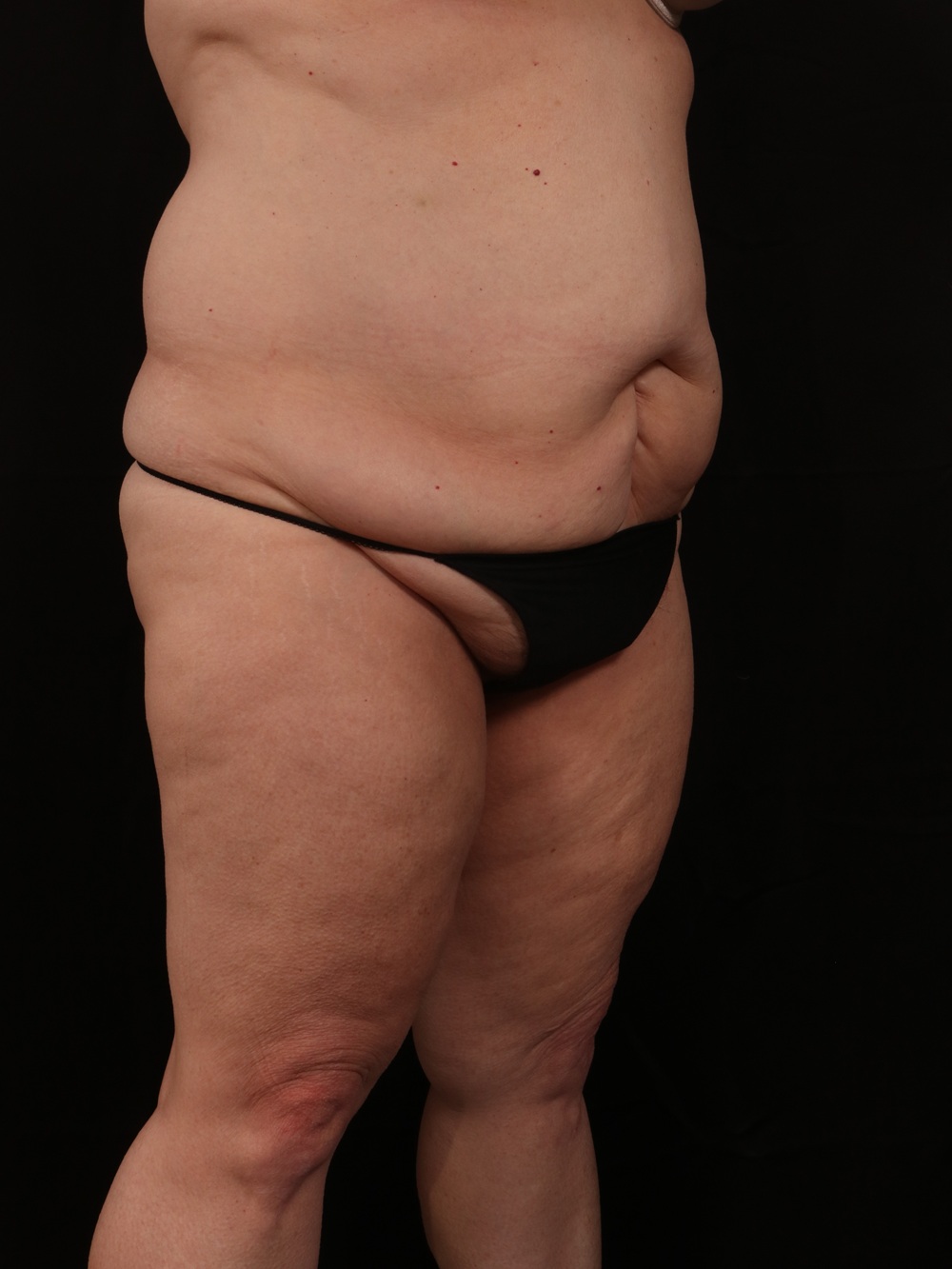 Before Image: Tummy Tuck - right-front-oblique