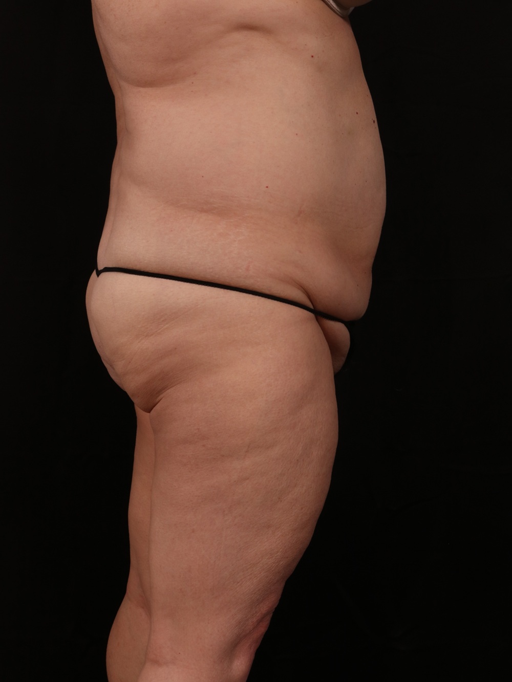 Before Image: Tummy Tuck - right-side