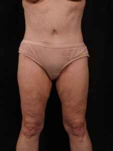 After Image: Tummy Tuck