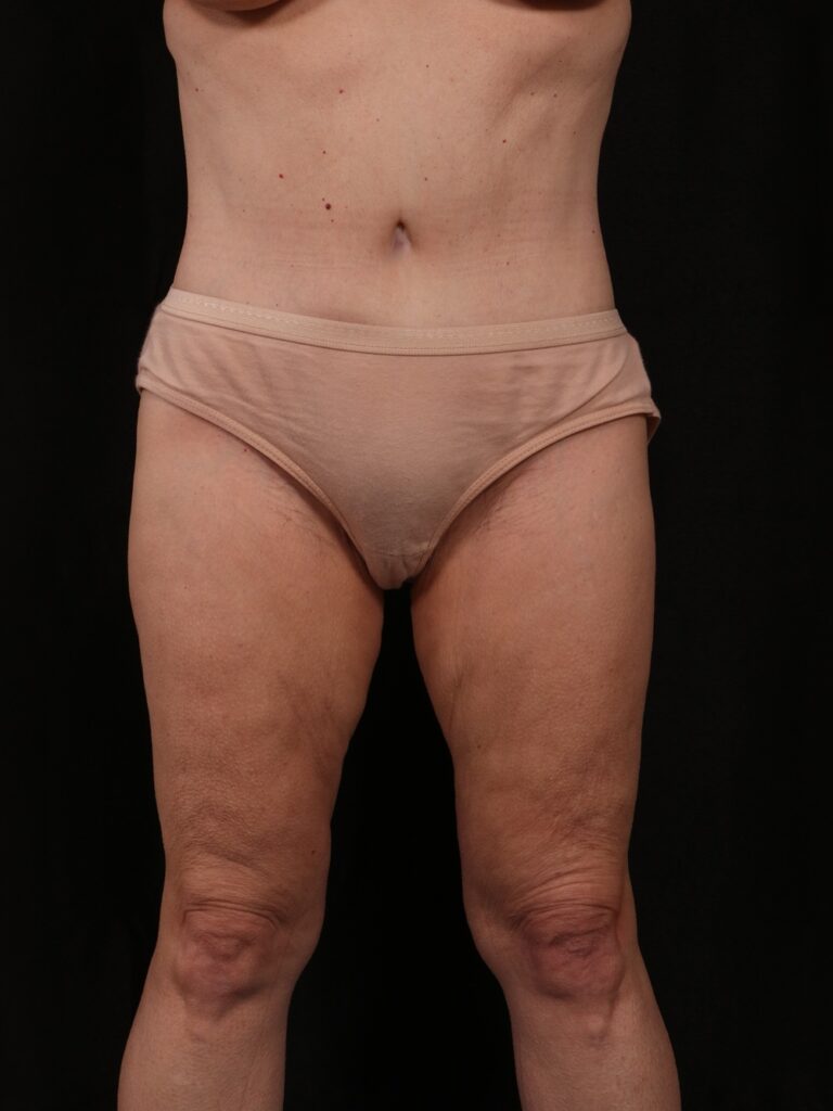After Image: Tummy Tuck - front