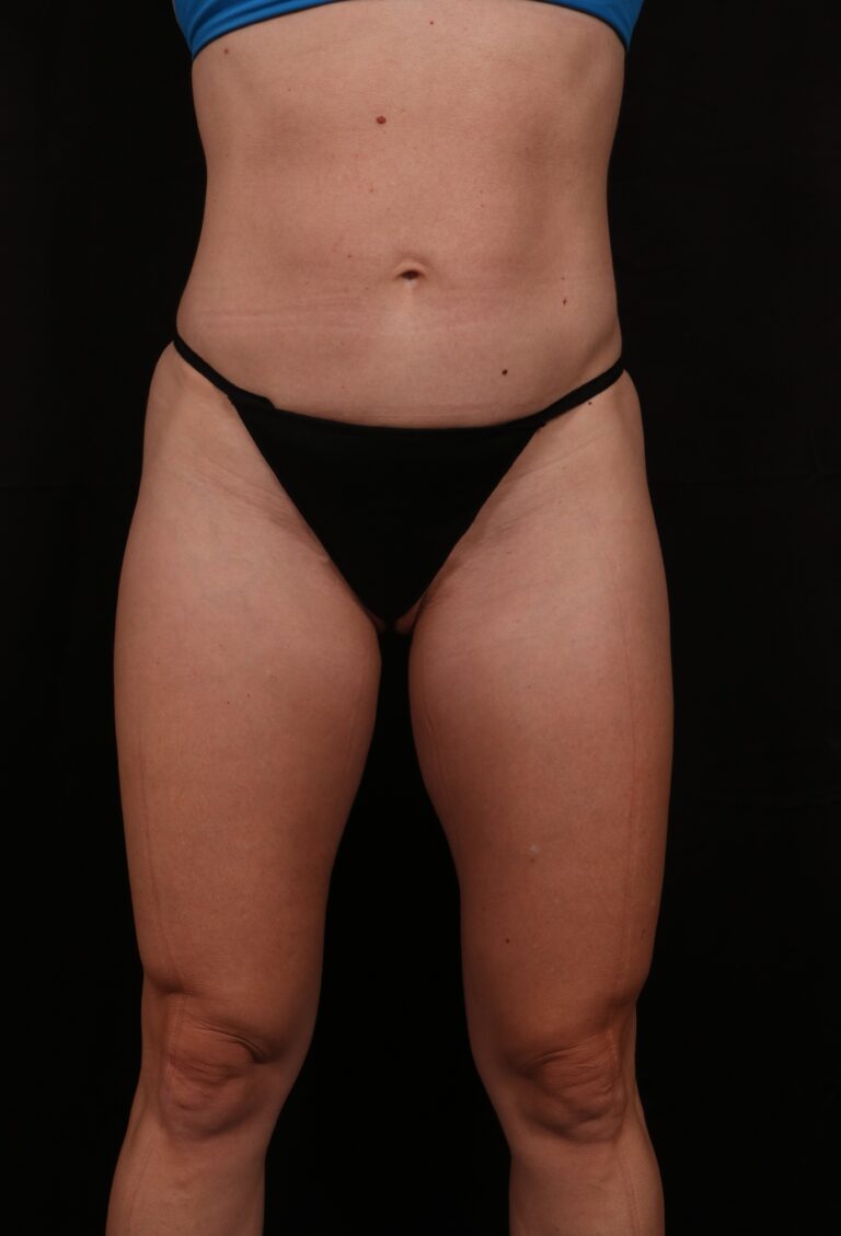 Before Image: Mini Tummy Tuck (Abdominoplasty) - front