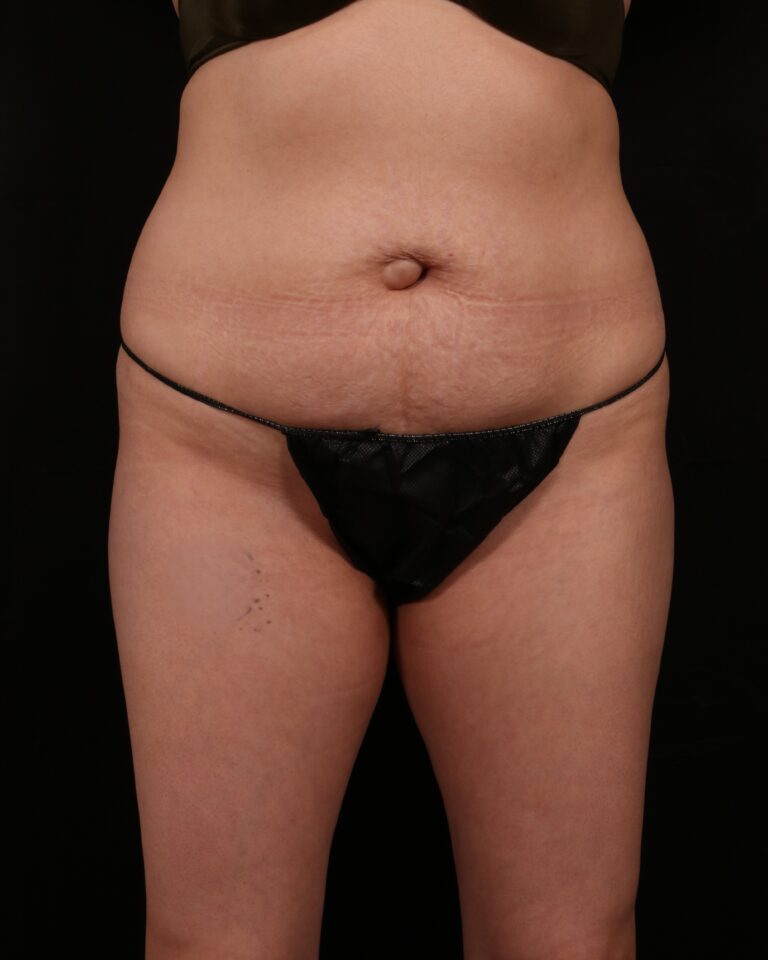 Before Image: Tummy Tuck - front