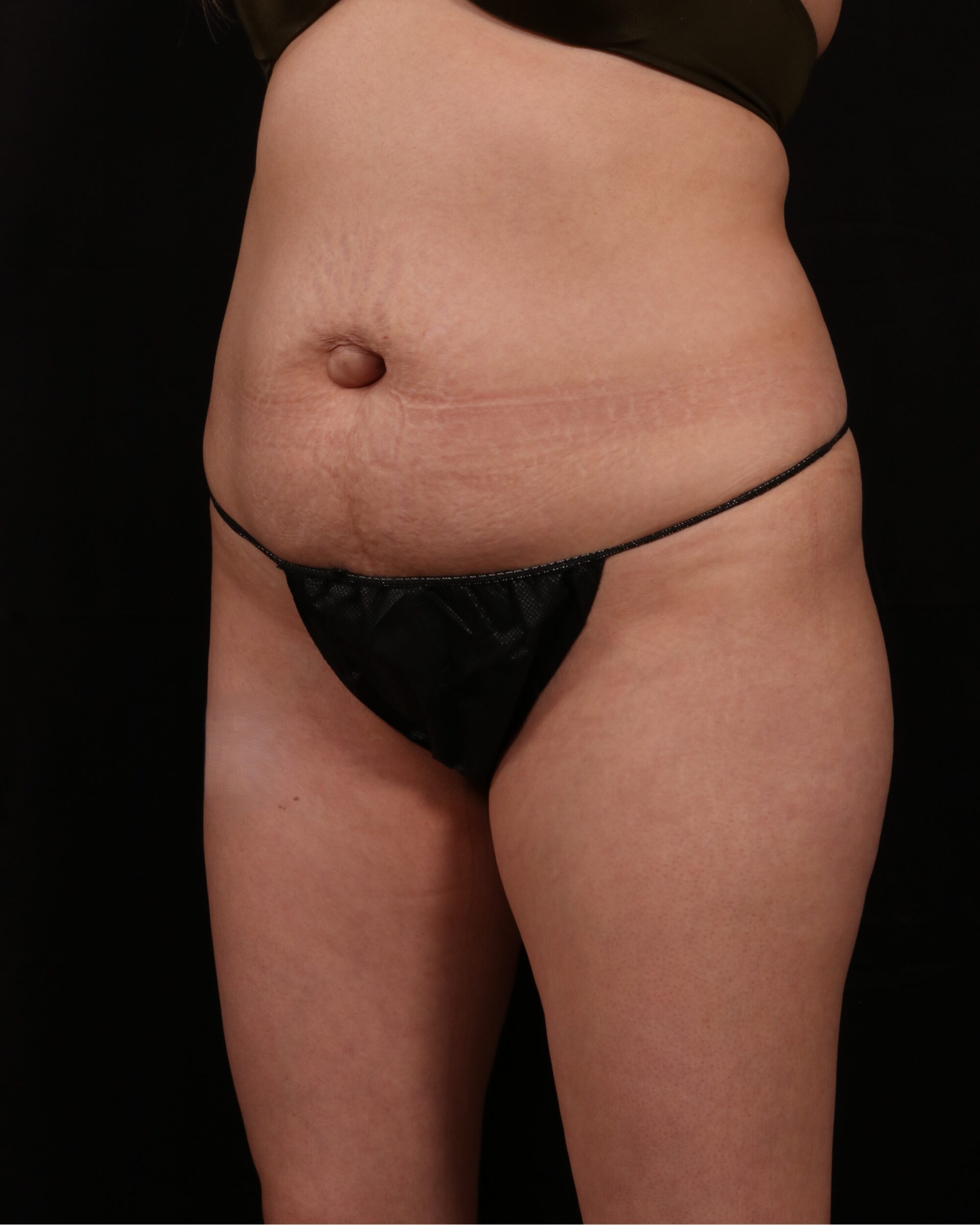 Before Image: Tummy Tuck - left-front-oblique