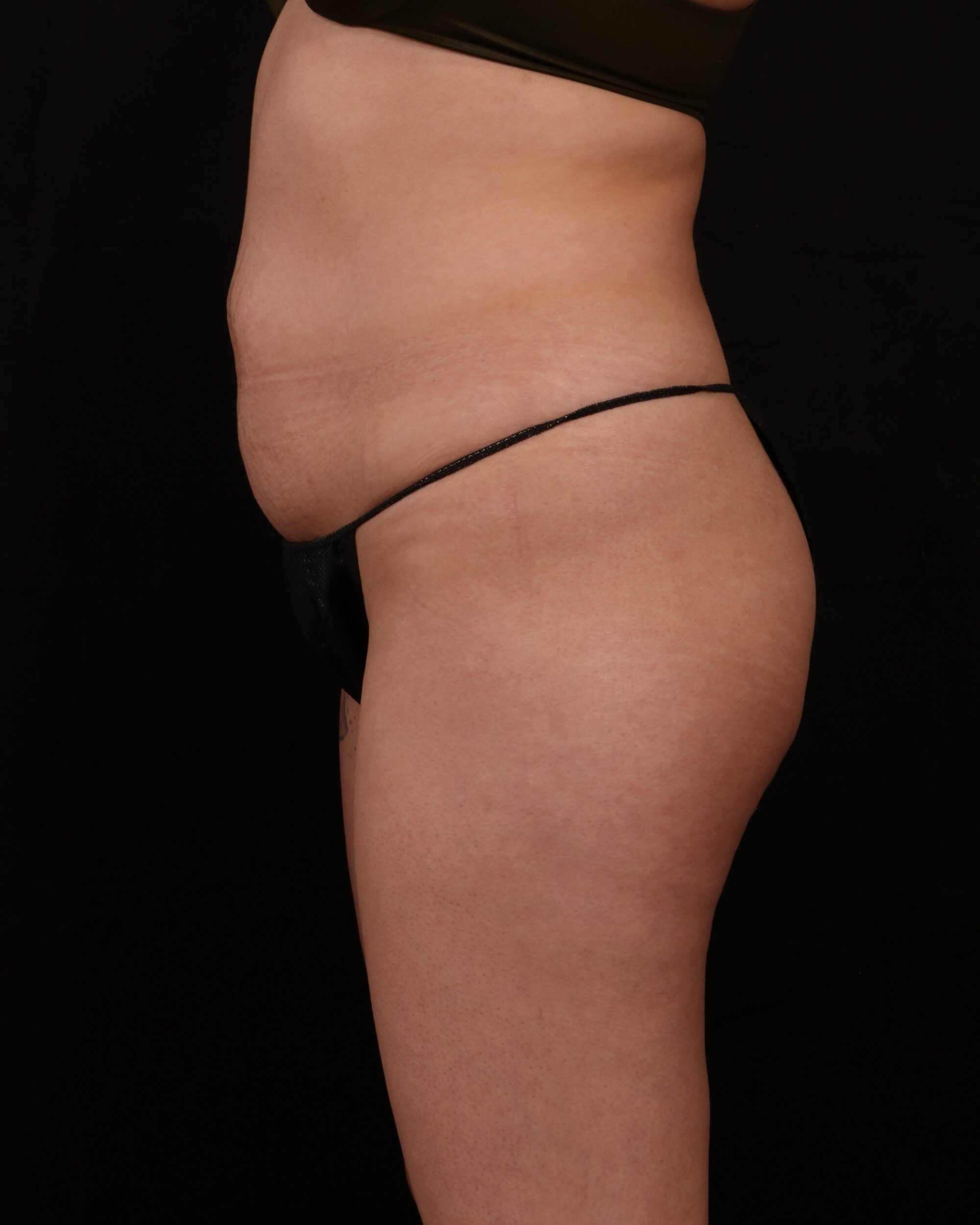 Before Image: Tummy Tuck - left-side