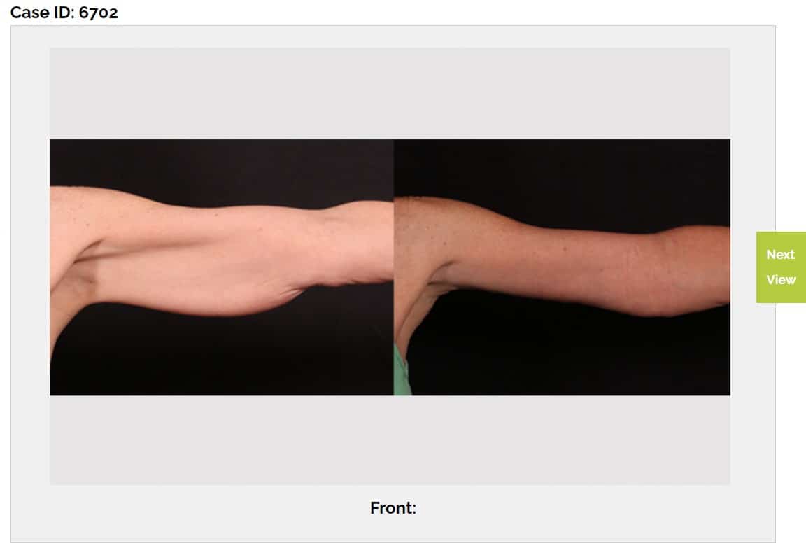 before after Arm Lift Austin TX