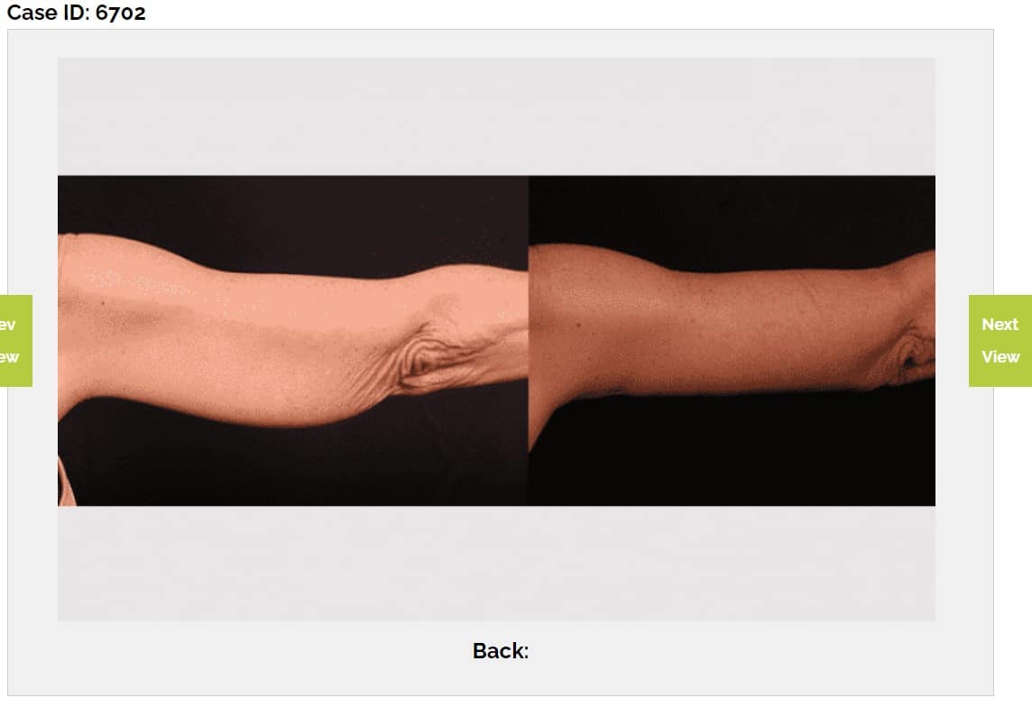 before after Arm Lift surgery Austin TX