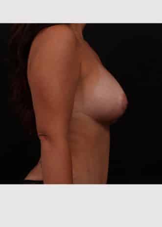 After Image: Breast Lift with Augmentation - right-side