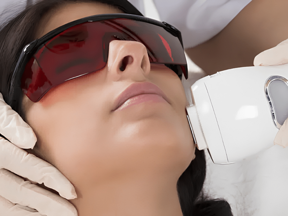 IPL Photofacial