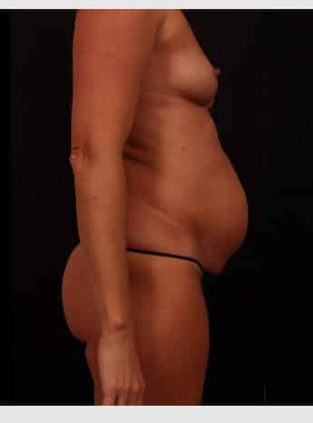 Before Image: Mommy Makeover - right-side