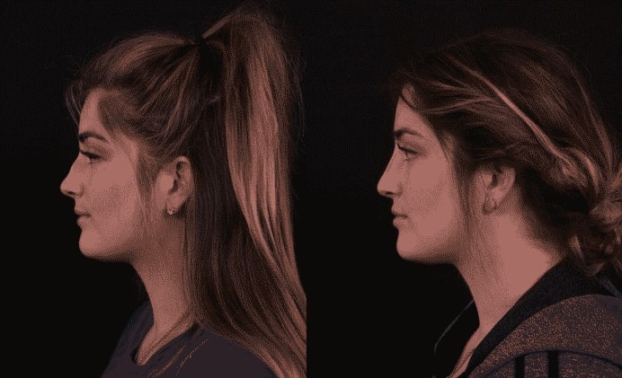 before and after Non-Surgical Nose Job Bee Cave TX