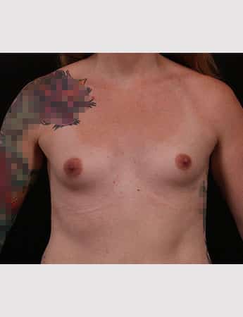 Before Image: Transgender Breast Augmentation - front