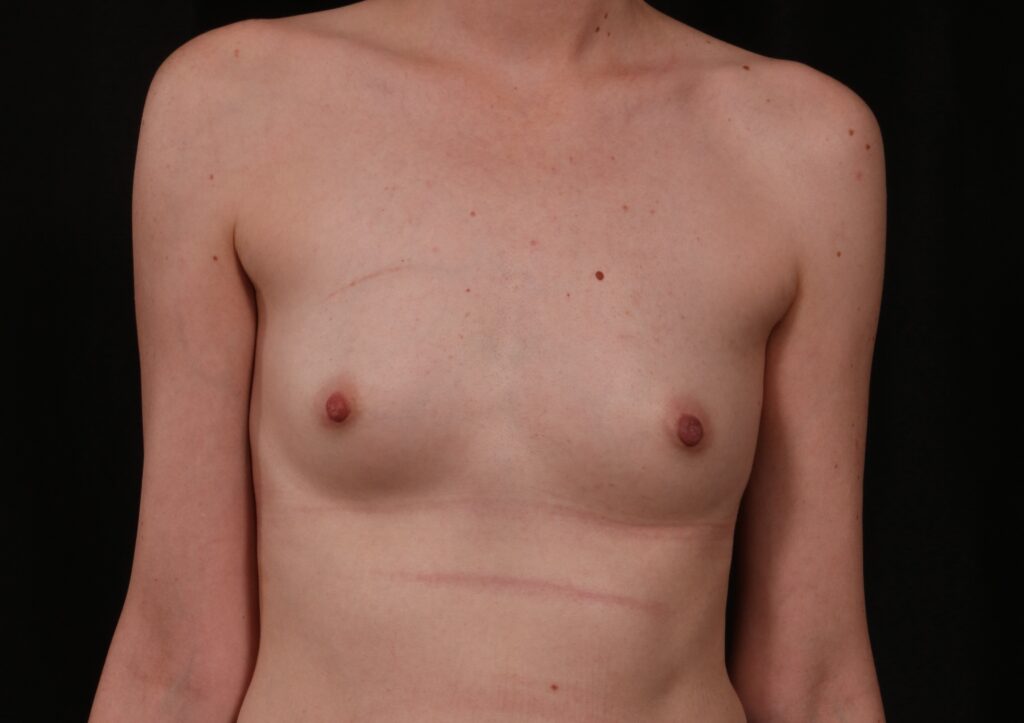Before Image: Breast Augmentation - front