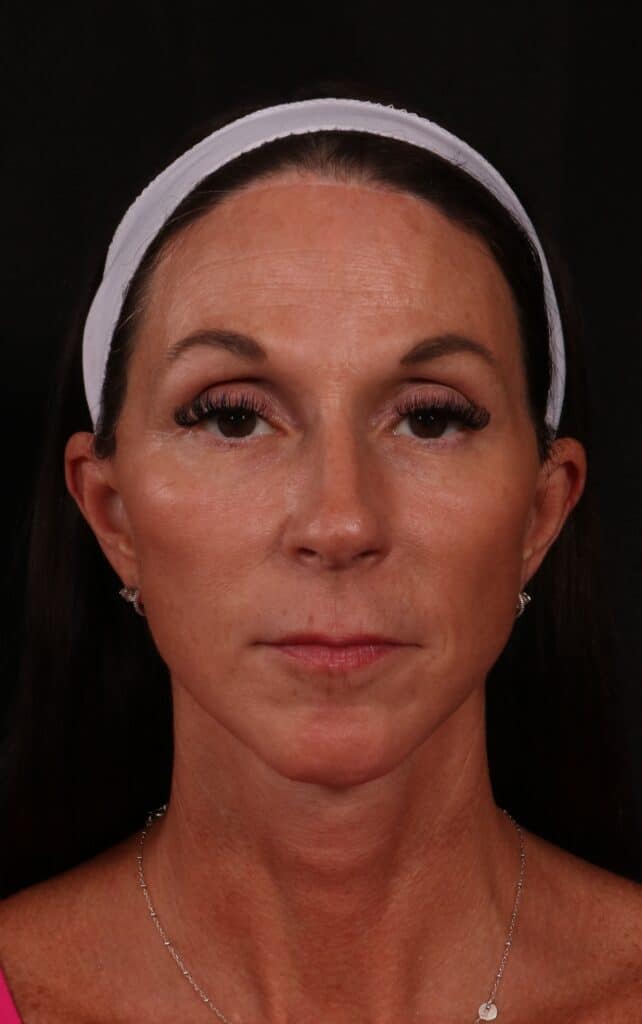 After Image: Facelift - front
