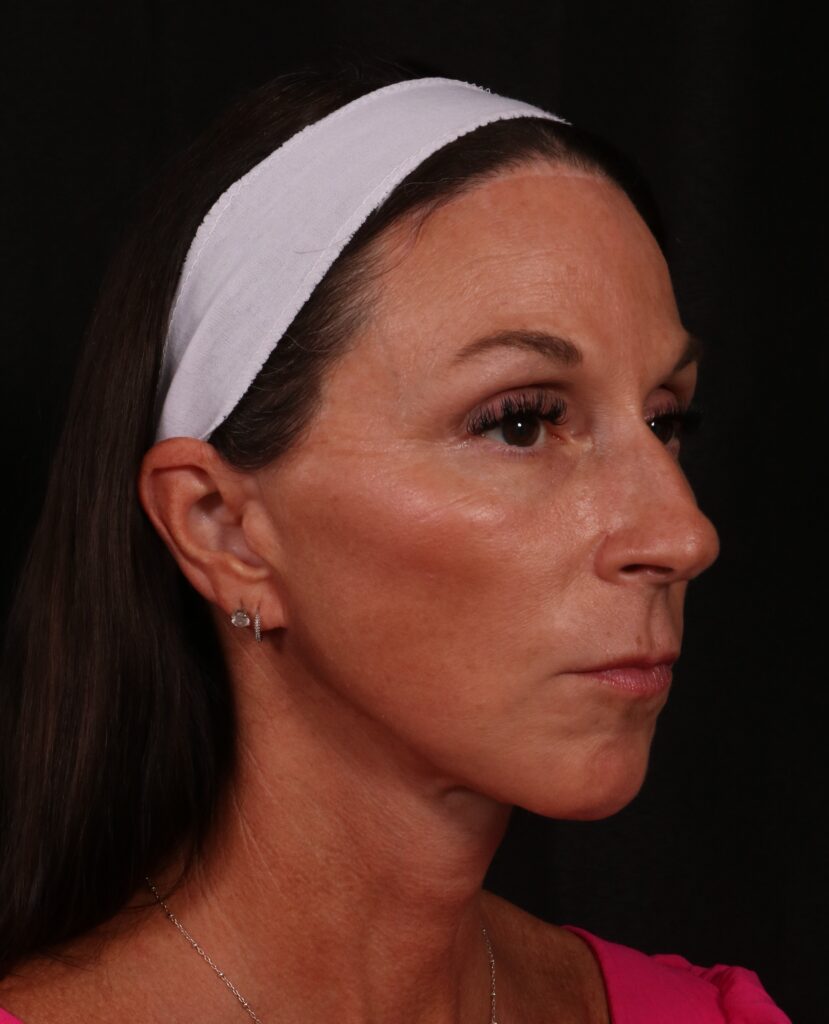 After Image: Facelift - right-front-oblique