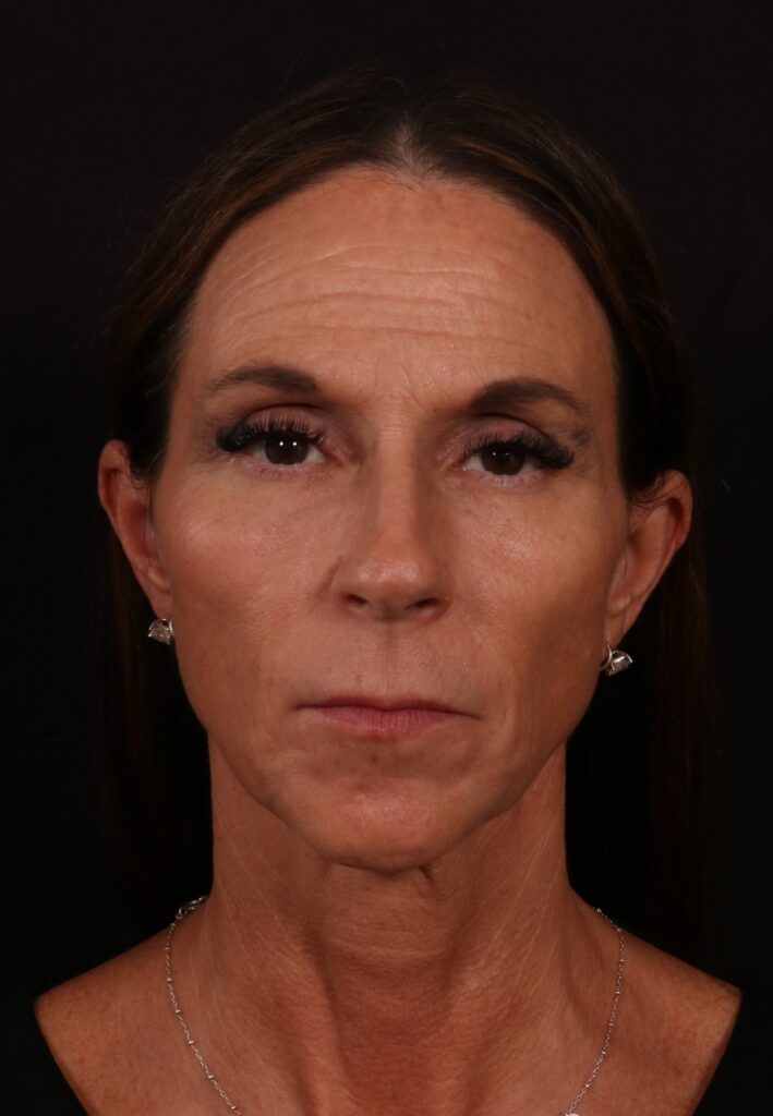 Before Image: Facelift - front