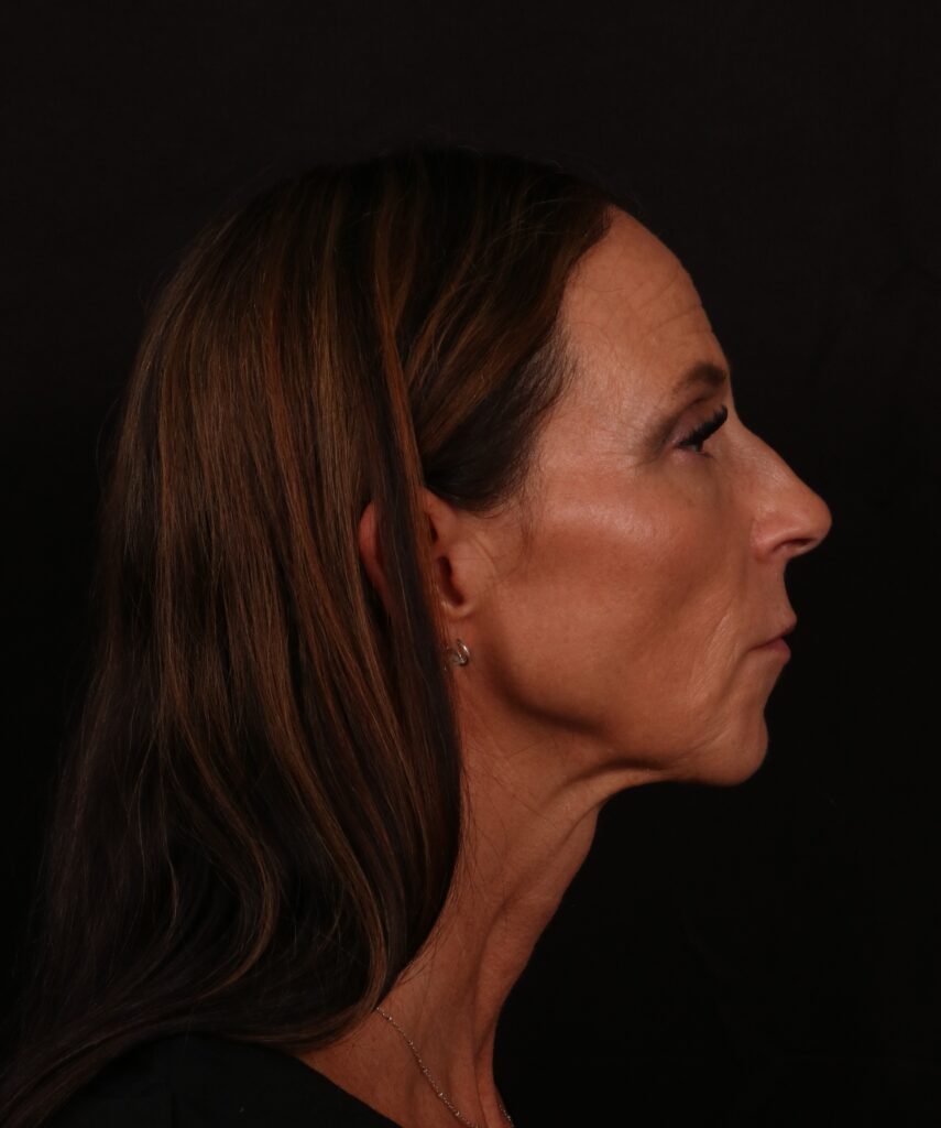 Before Image: Facelift - right-side